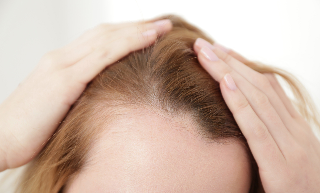 Dermatologie-Haarausfall